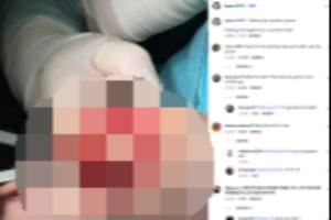 恐怖慎点😨库卢塞夫斯基晒重伤部位手术照：感谢上天让我看清